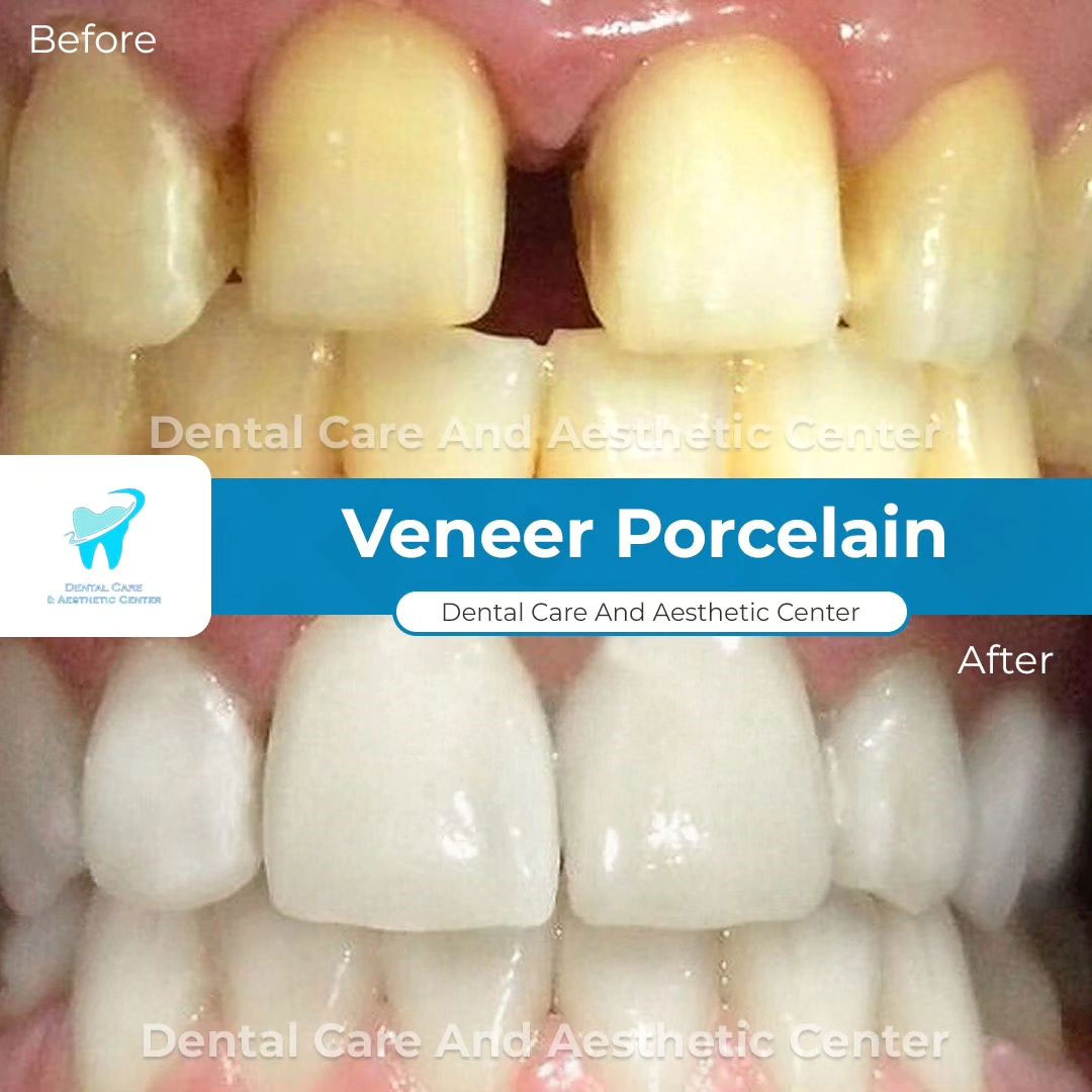 Veneer Porcelain