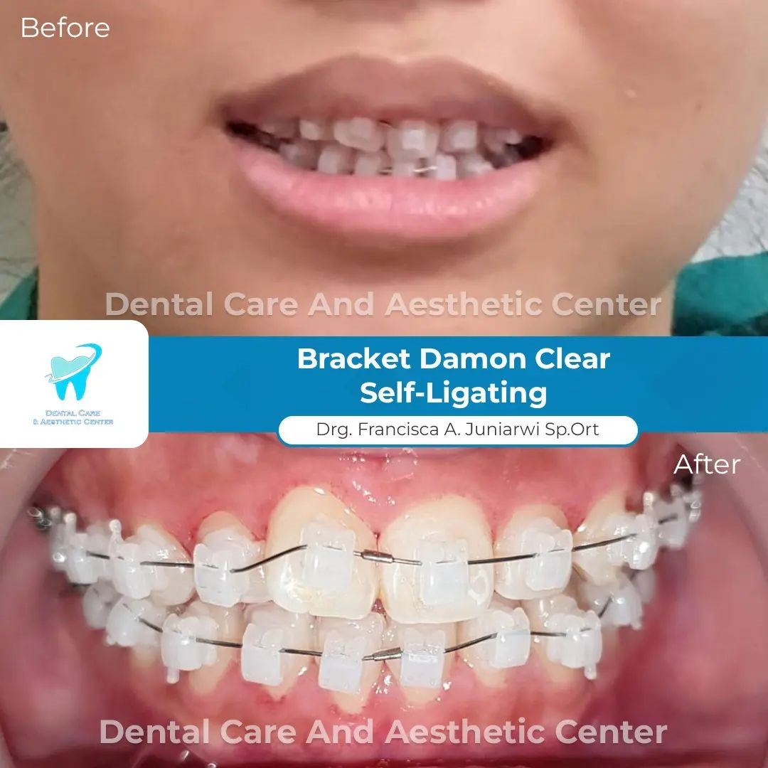 Bracket Damon Clear Self-Ligating