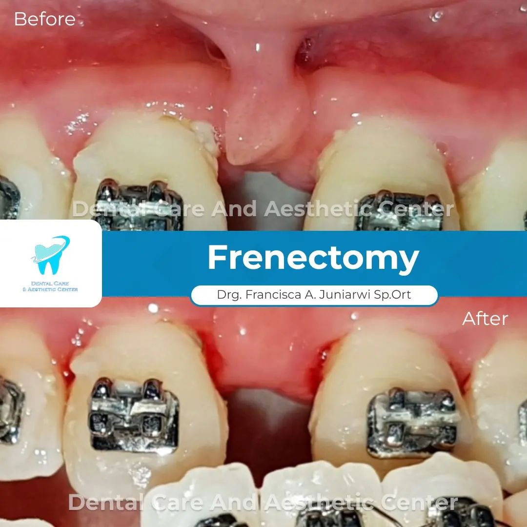 Frenectomy